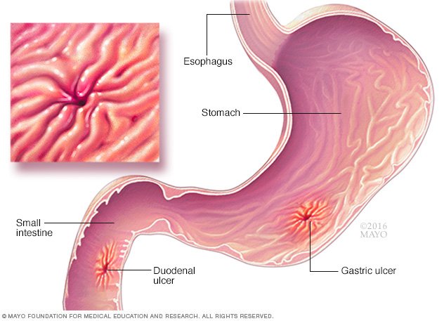 Peptic Ulcer Disease Reference Guide Drugs